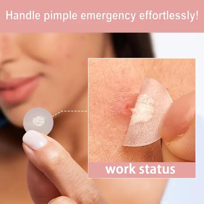 Patch anti-acné hydrocolloïde
